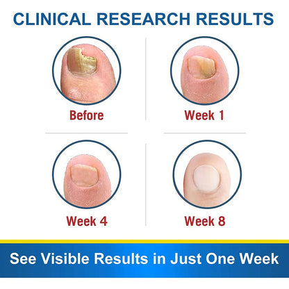 7-Tage-Nagelpilz-Behandlungsserum, Pflege für Hände und Füße, Entfernung