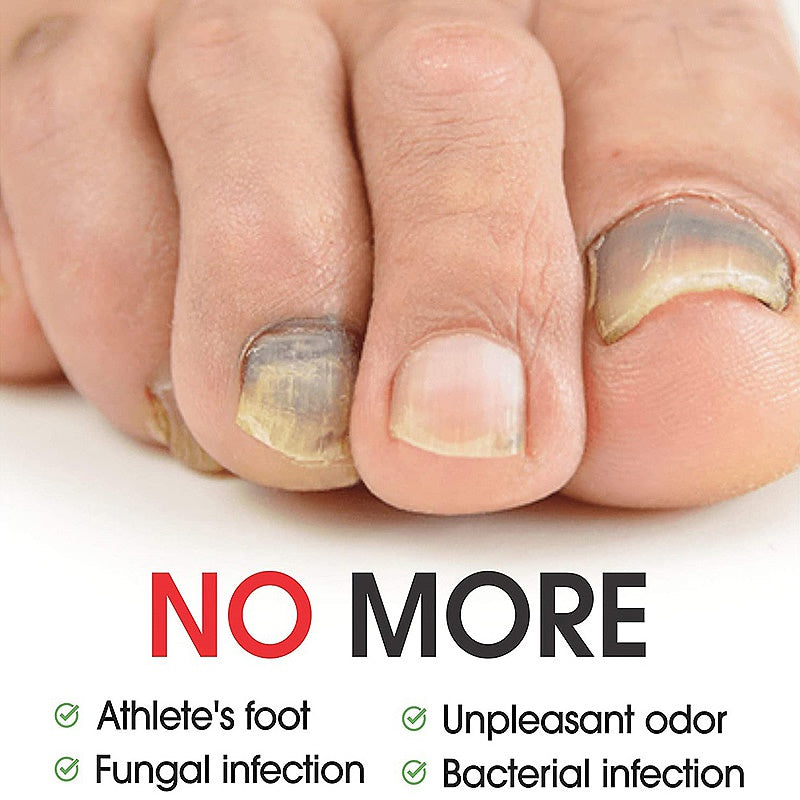7-Tage-Nagelpilz-Behandlungsserum, Pflege für Hände und Füße, Entfernung