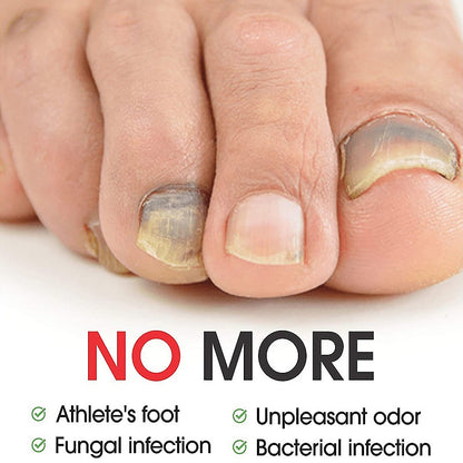 7-Tage-Nagelpilz-Behandlungsserum, Pflege für Hände und Füße, Entfernung