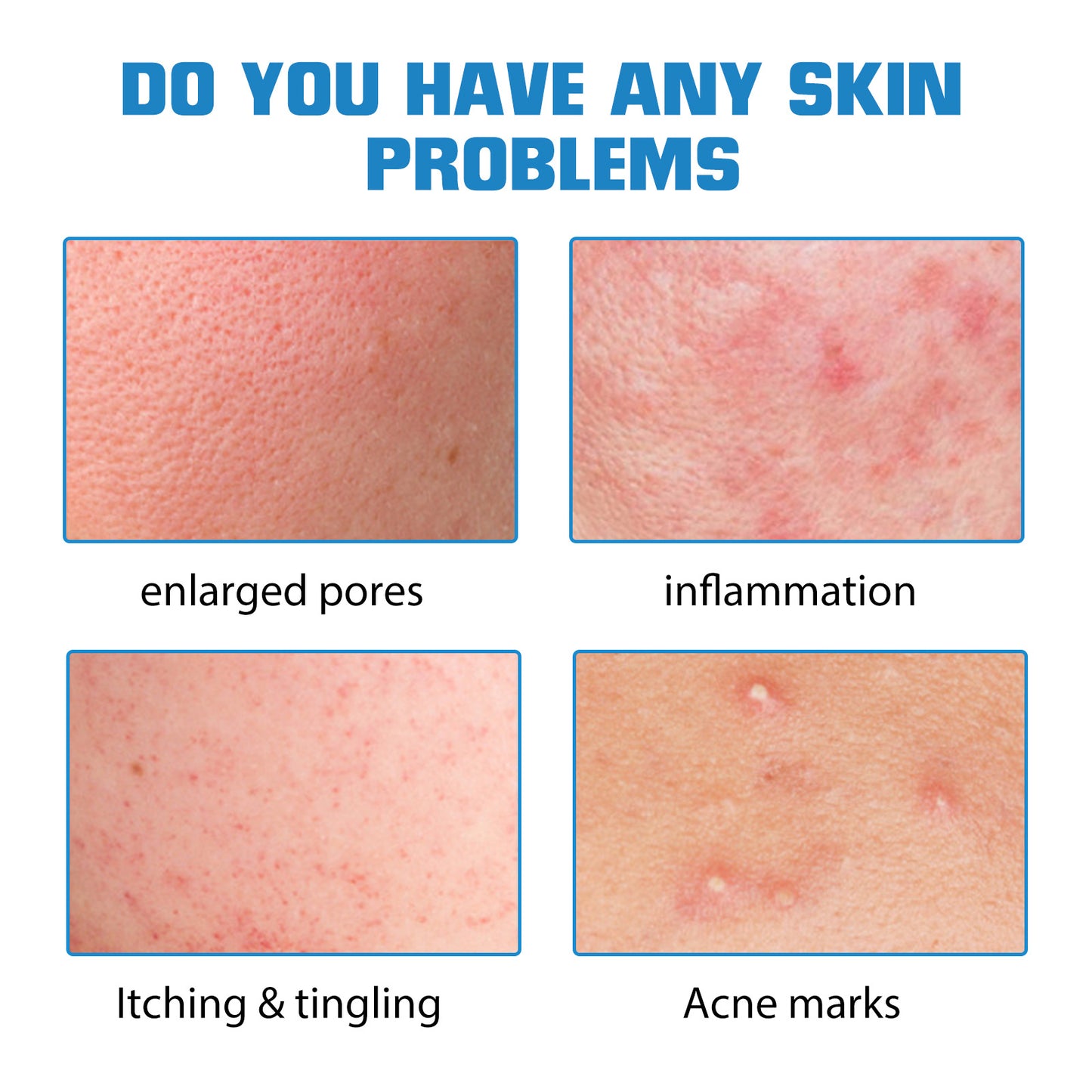 Hyaluronsäure-Auffüllung