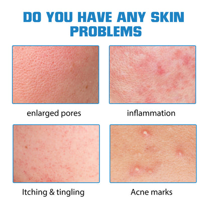 Hyaluronsäure-Auffüllung