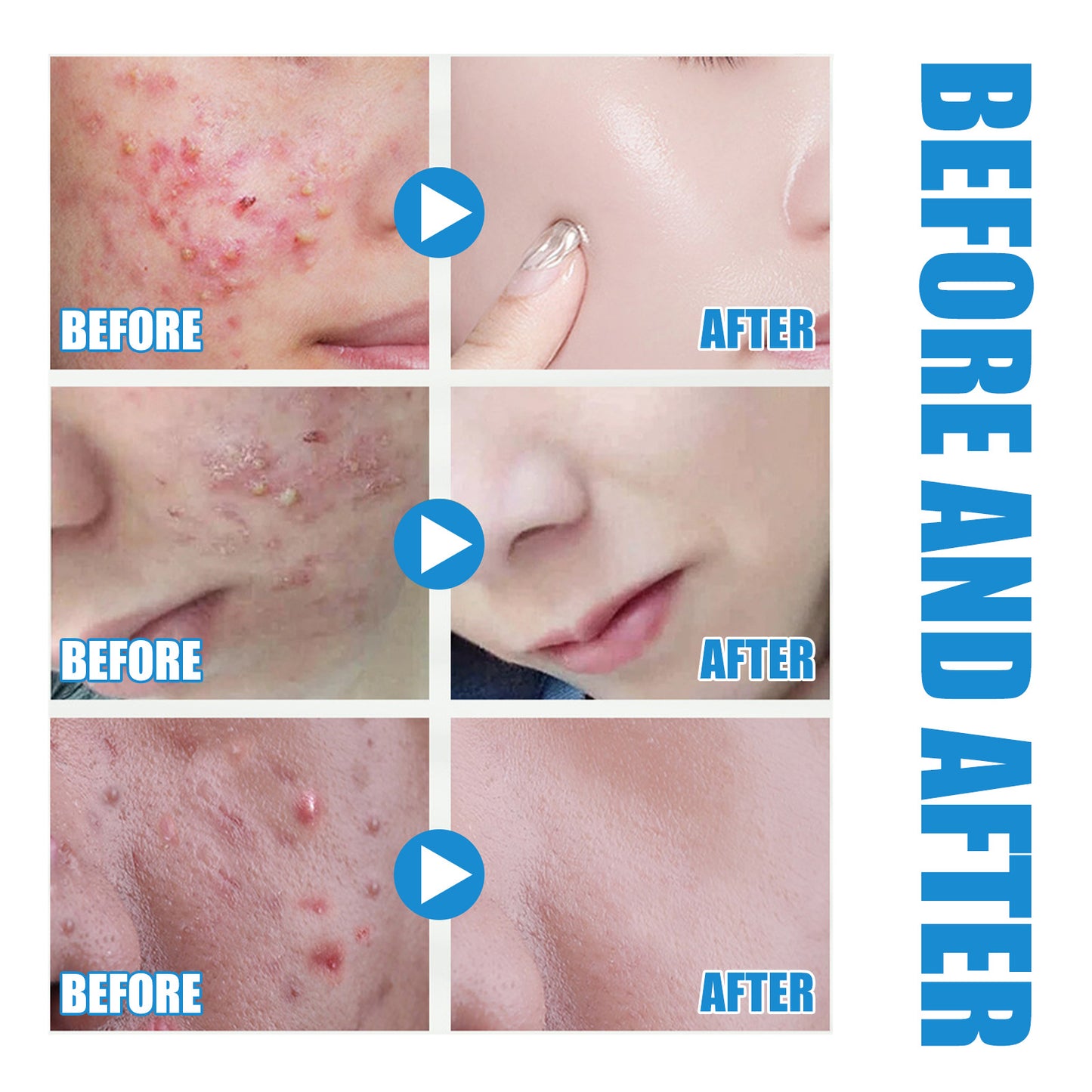 Hyaluronsäure-Auffüllung