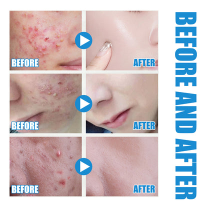 Hyaluronsäure-Auffüllung