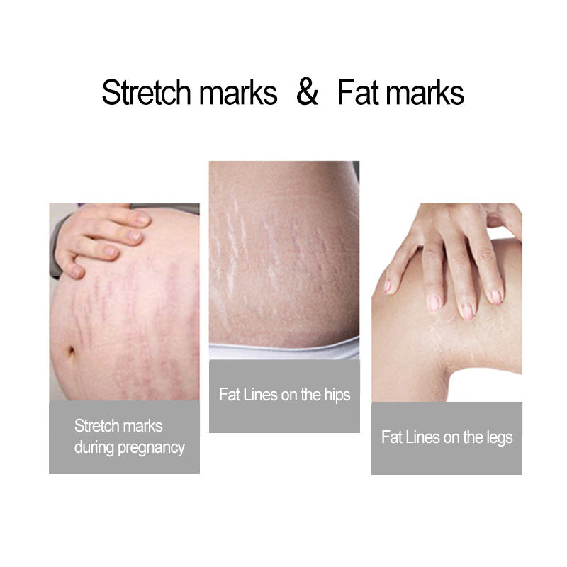 Fettleibigkeitsfalten, Schwangerschaftsfalten, Orangenhaut-Tattoo, Körpermassage